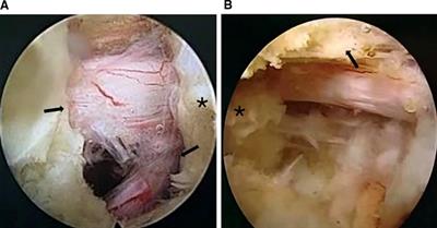 Can the Full-Percutaneous Endoscopic Lumbar Discectomy in Day Surgery Mode Achieve Better Outcomes Following Enhanced Recovery after Surgery Protocol? A Retrospective Comparative Study